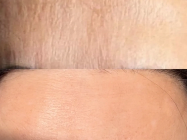 microneedling and nctf skin improvement and texture refinement