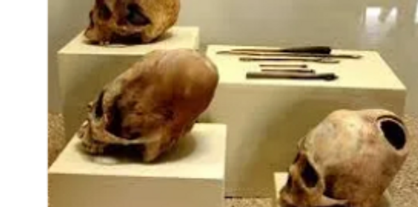 Trepanations cranial  were practiced during life by the Paracas culture,          Paracas museum.