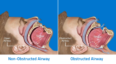 Demonstration of Obstructed Airway