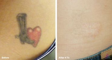 before and after photo of a heart tattoo with a gun