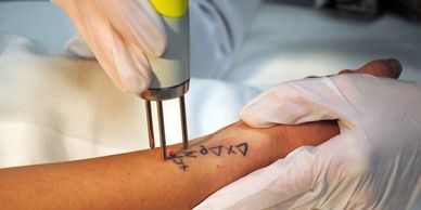 Laser removal process