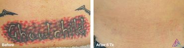 before and after photo of a "ghoul child" tattoo