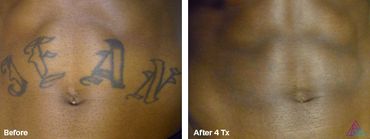 "JEAN" tattoo before and after photo