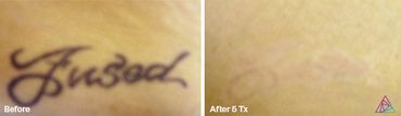 before and after photo of the text "Fusod" tattoo