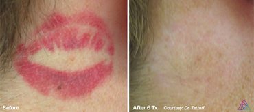before and after photo of a kiss tattoo