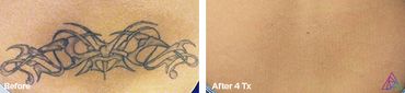 before and after photo of a tribal butterfly tattoo
