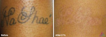 "Na Shae" tattoo before and after photo