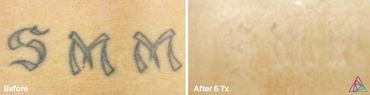 before and after photo of an "S M M" tattoo