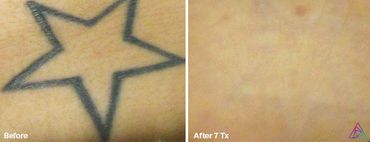before and after photo of a star tattoo