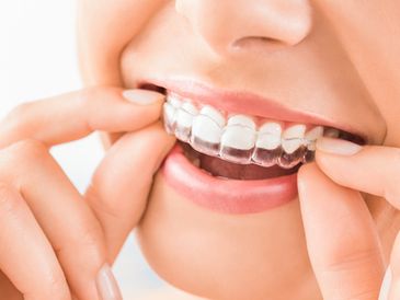 ALIGNERS. INVISALIGN