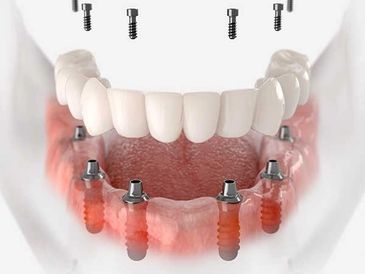 ALL ON 4
ALL ON 6
Full denture on multiple implants