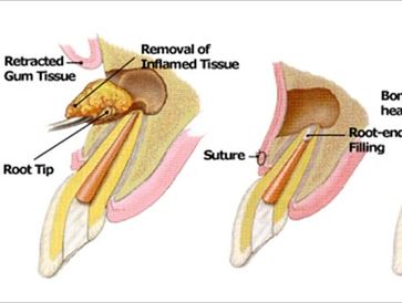 Apicoectomy procedure