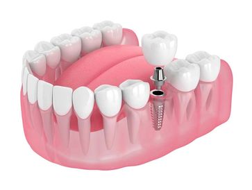 SINGLE DENTAL IMPLANT