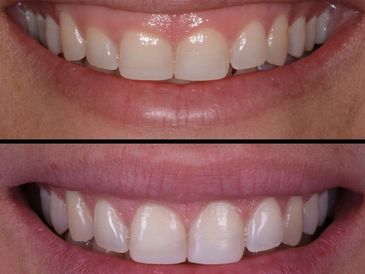Before and after of GUMMY SMILE treatment