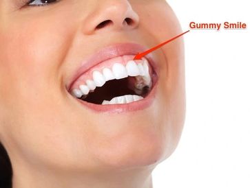 patient with GUMMY SMILE