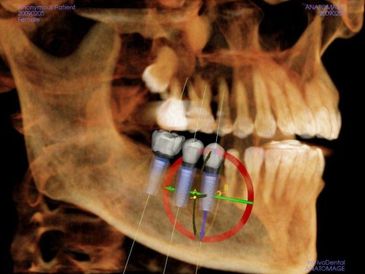 Digitally guided implant surgery