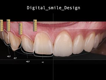 Digital smile design. The template of a new smile projected over the old
