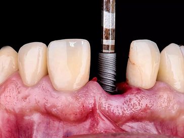 Dental implant placement