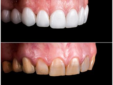 before and after picture in dental veneer treatment