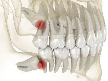 Impacted wisdom tooth