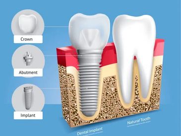 Dental implant parts