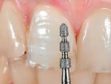 A depth cutter bur used to determine the depth of enamel that needs to be reduced for dental veneers