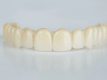 Temporary dental veneers