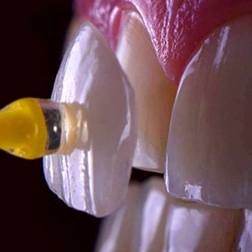 Single dental veneer being fitted on natural tooth