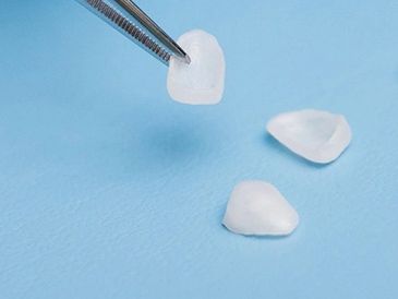 This picture shows dental laminate veneers