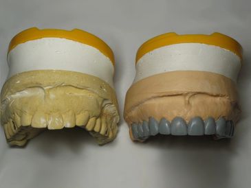 Cast of teeth before and after a "wax up" where the dental lab designs a new model of teeth over old