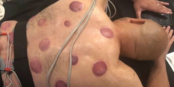 Cupping Therapy at Pinky Promise Beauty Chicago weight loss center noninvasive treatments
