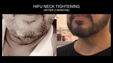 HIFU on chin area before and after pictures with amazing results guarantee. In Chicago, Logan