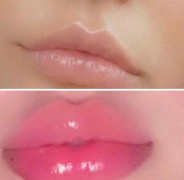 Pinky promise lip filler results pictures. Pinky Promise Beauty lip treatment.