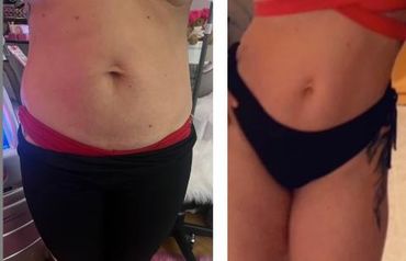 Best treatment for fat in Chicago, before and after pictures, great results with one treatment.