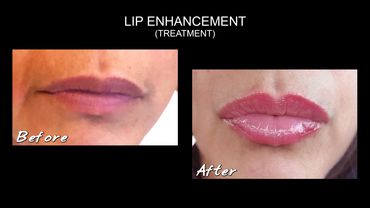 Lip filler results before and after treatment 1 syringe on sale in Chicago, IL Logan Square area.