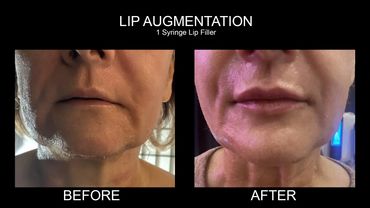 Best lip augmentation before and after pictures of results with lip filler in Chicago, IL