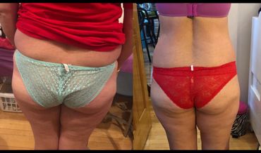 4 Fat Freeze Applicators and HIFU