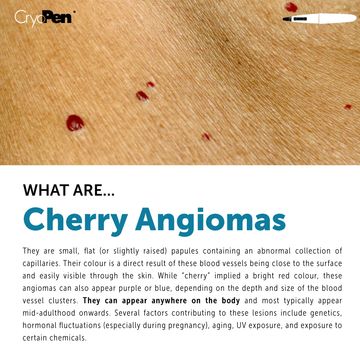 Close-up of cherry angiomas on skin with informational text.