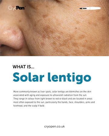 Close-up of skin with solar lentigo spots.