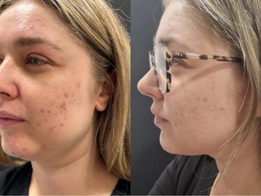 LED Dermalux Triwave MD skin