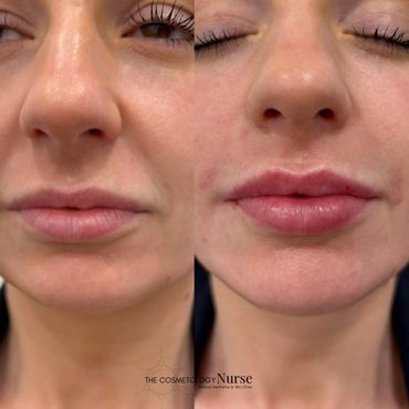 Lip Filler
