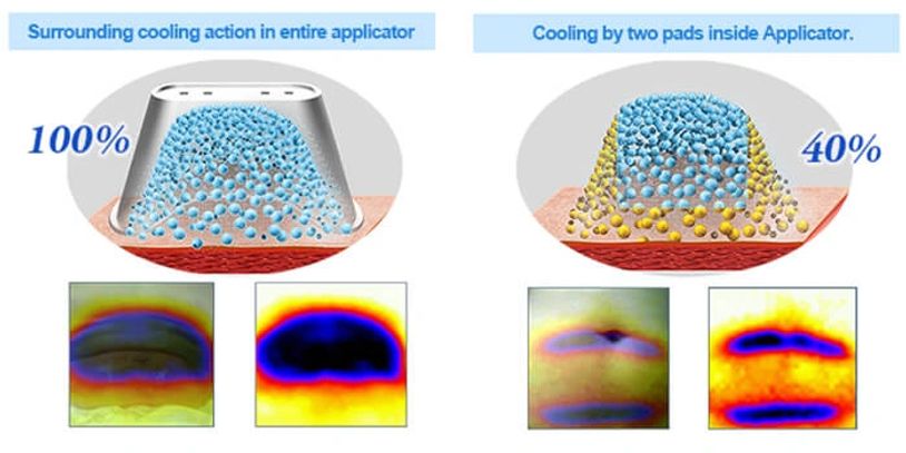 360 degree cryolipolysis fat freezing