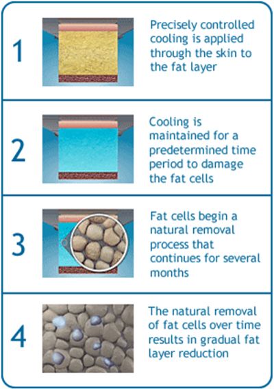 About Cryolipolysis and fat freezing