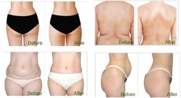 Before and after cryolipolysis fat freezing photos