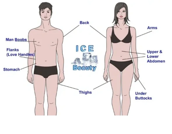 What areas can cryolipolysis fat freezing treat