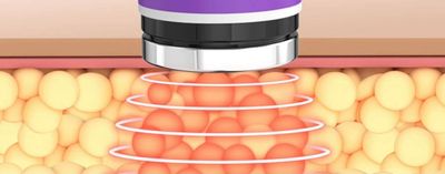 Cavitation fat freezing near me Somerset devon
