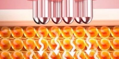 Radio frequency RF skin tightening and wrinkle reduction devon and somerset