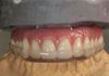 Processed Bruxism Splint fabricated for new Screw Retained Hybrid