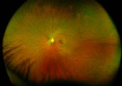 Digital Wide-Field Retinal Image