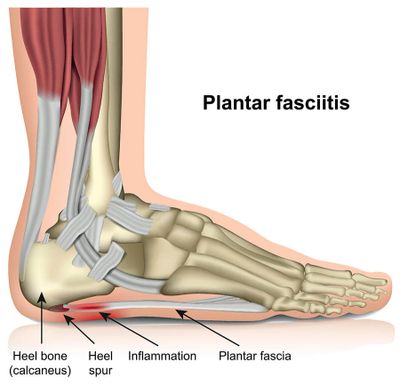 Plantar Fasciitis Illustration. David Fernandez Personal Trainer.